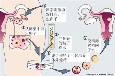 人工同志借卵代怀服务怎么找试管婴儿中心
